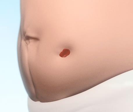 Cilt Seviyesinde Stoma