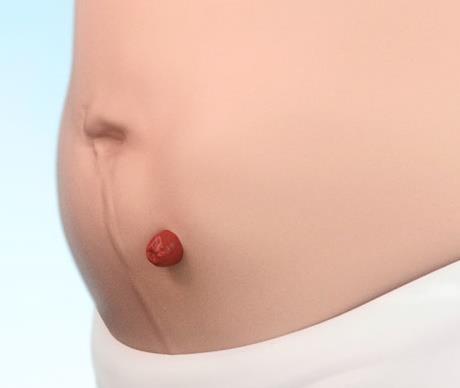 Dışarıda / Çıkıntılı Stoma